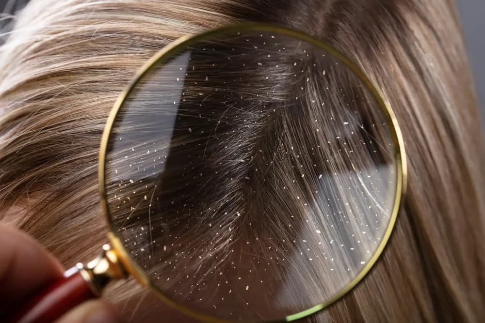 Dandruff and itchy scalp